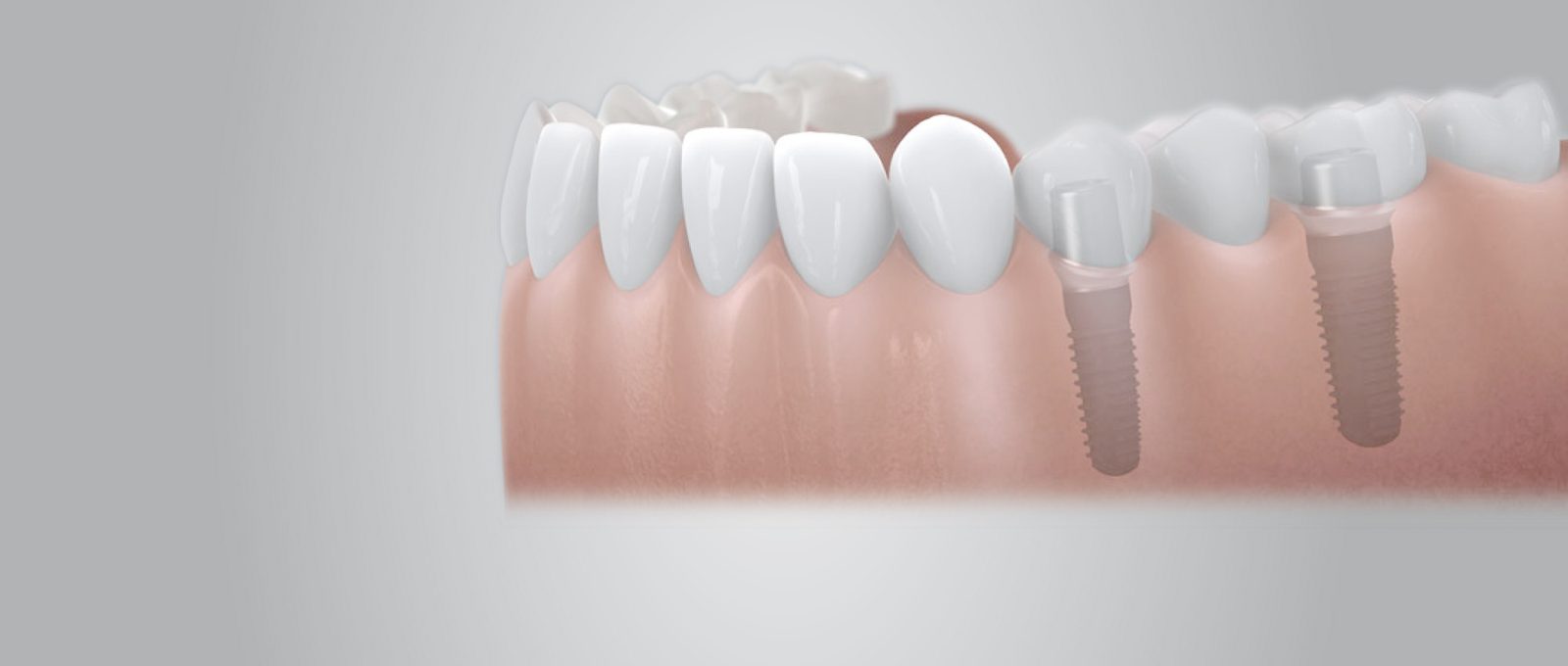 Grafik eines Kiefers mit Implantaten